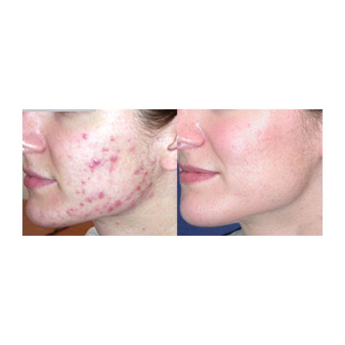 Acne Free Complexion Cashback - RebateKey