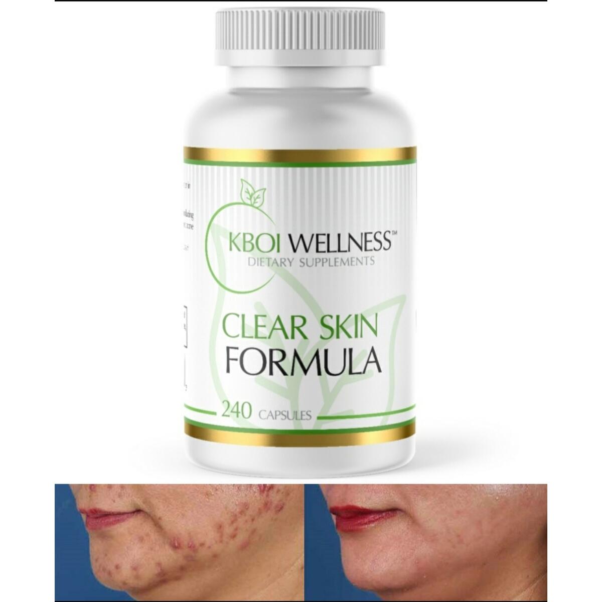 Acne Free Complexion Cashback - RebateKey