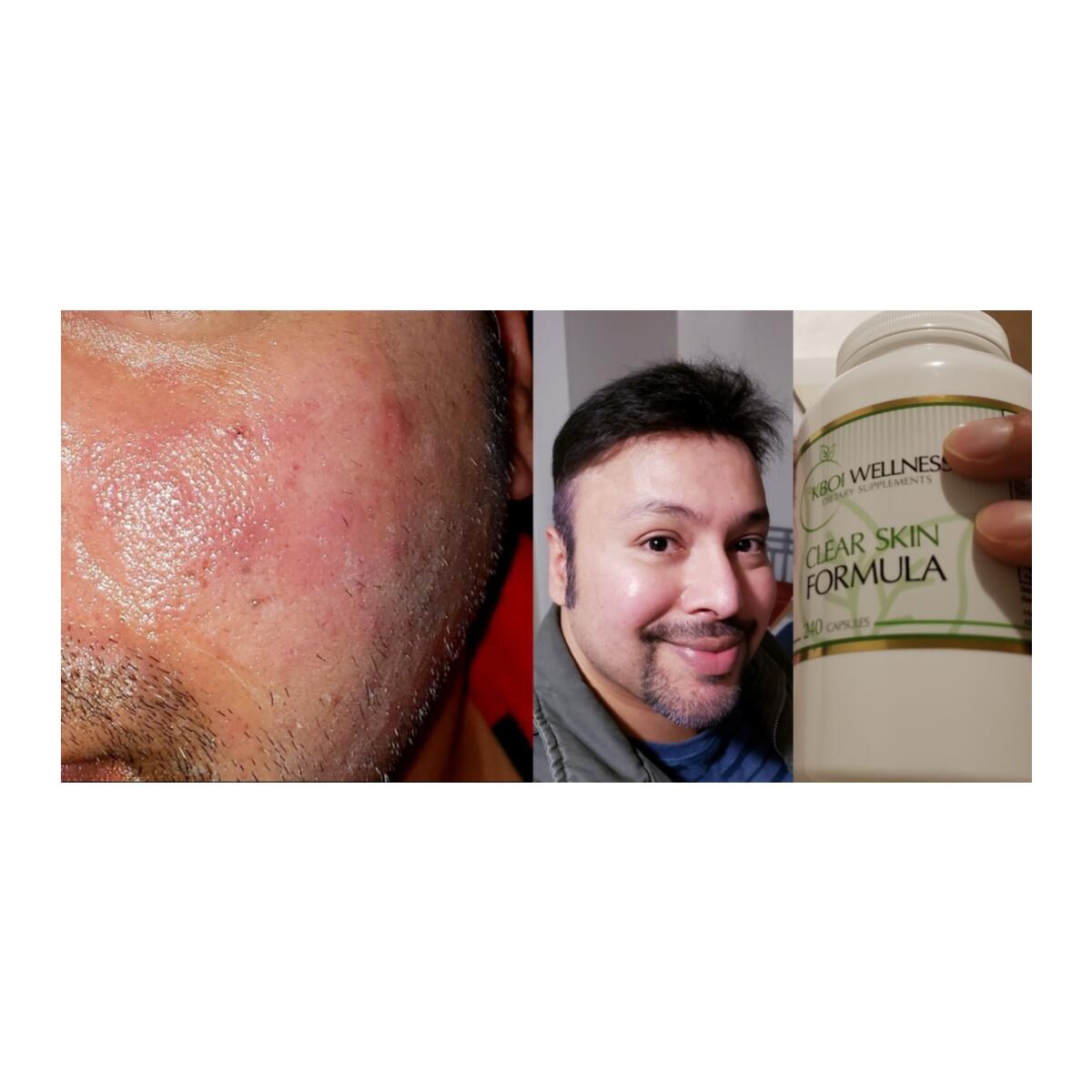 Acne Free Complexion Cashback - RebateKey